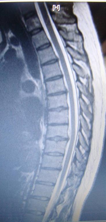 thoracic disc herniation treated by Williamson chiropractor